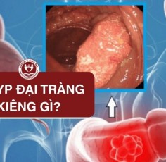 7 Nhóm Thực phẩm Người Bị Polyp Đại Tràng Nên Tránh Xa